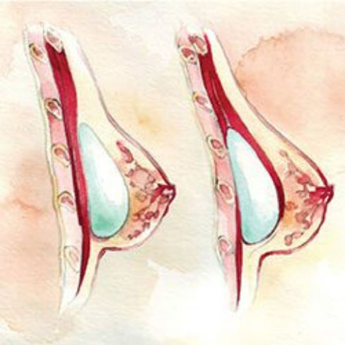 Subglandular and submuscular placement