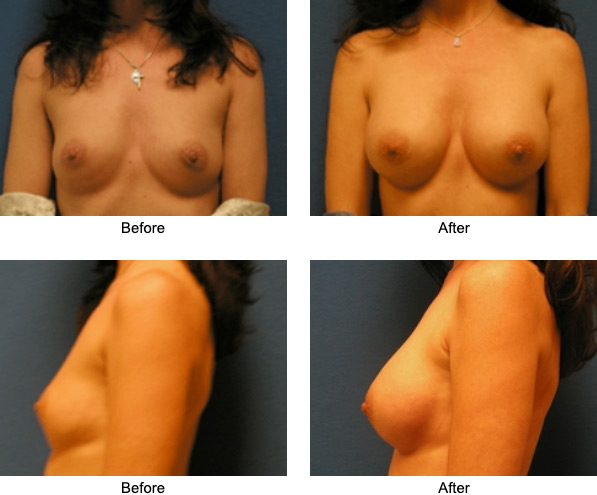 Breast Implants before and after