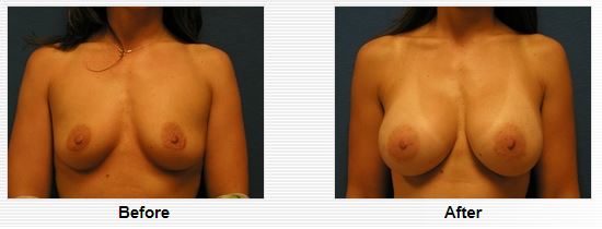 Breast augmentation before-and-after photos