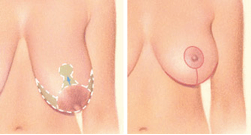 Sagging breast on left with dashed line around areola, down to breast crease, and along breast crease. Reshaped breast with red incision line around areola and down to breast crease.