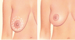Sagging breast on right with dashed lines around nipple and a second set farther out. Reshaped breast on left.