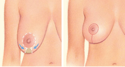 Sagging breast on left with dashed lines around areola that goes down to breast crease at the center of the lower areola. Reshaped breast on right with red incision line around the areola and down from center of areola to breast crease in a lollipop shape.