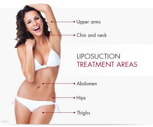 Smiling woman in white bikini with liposuction treatment areas specified as upper arms, chin and neck, abdomen, hips, thighs