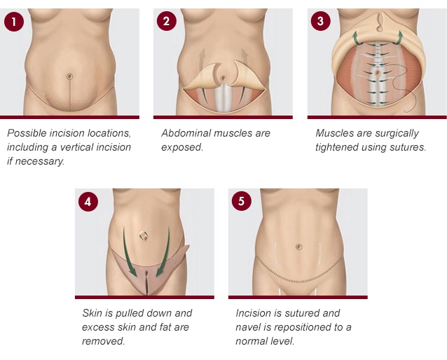 1. Horizontal incision made between hip bones 2. Skin lifted to expose ab muscles 3. Ab muscles tightened with sutures 4. Skin pulled down over ab muscles and excess removed 5. Navel repositioned and incision sutured